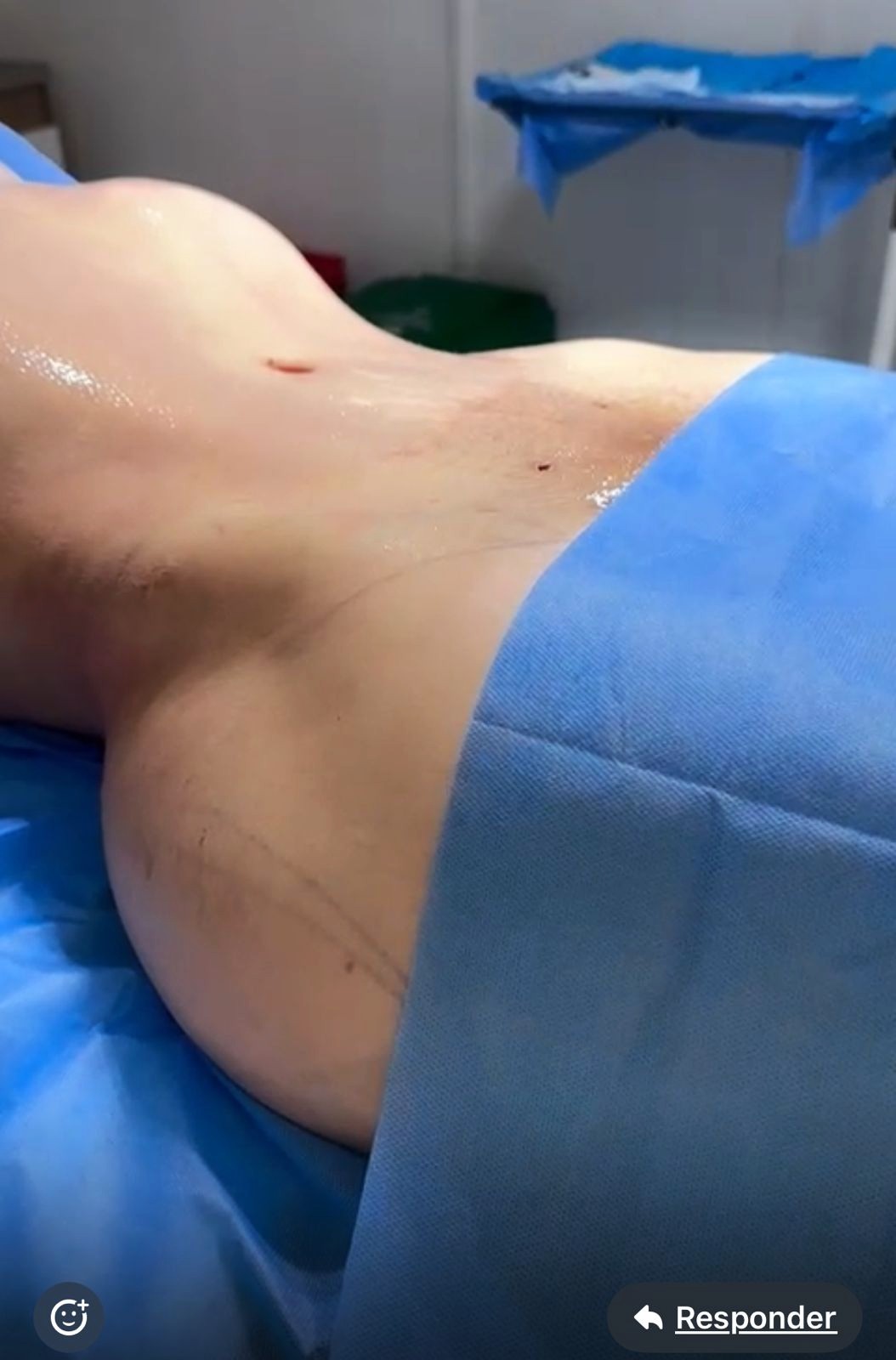 Cirugias Plásticas abdomenok